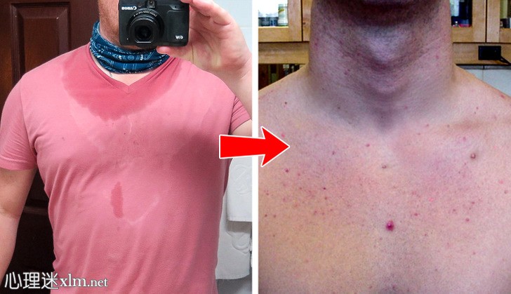 8个身体部位的痘痘试图告诉你的生活习惯