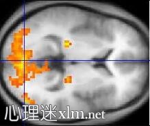 阿斯伯格综合症（Asperger’s Syndrome简称AS）