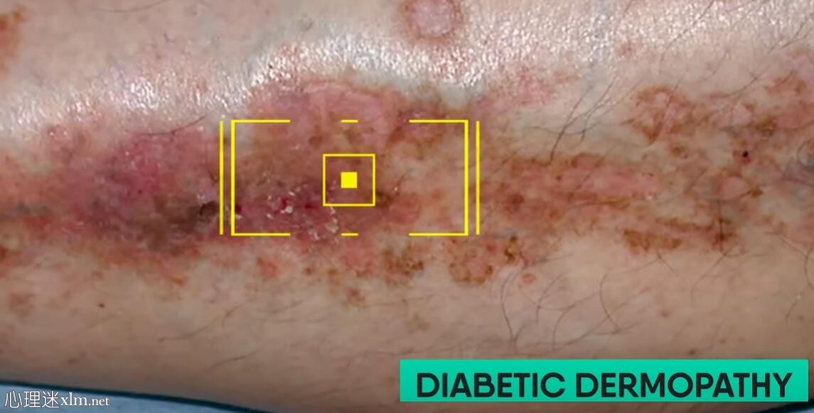 糖尿病时皮肤上出现的 12 个警告信号